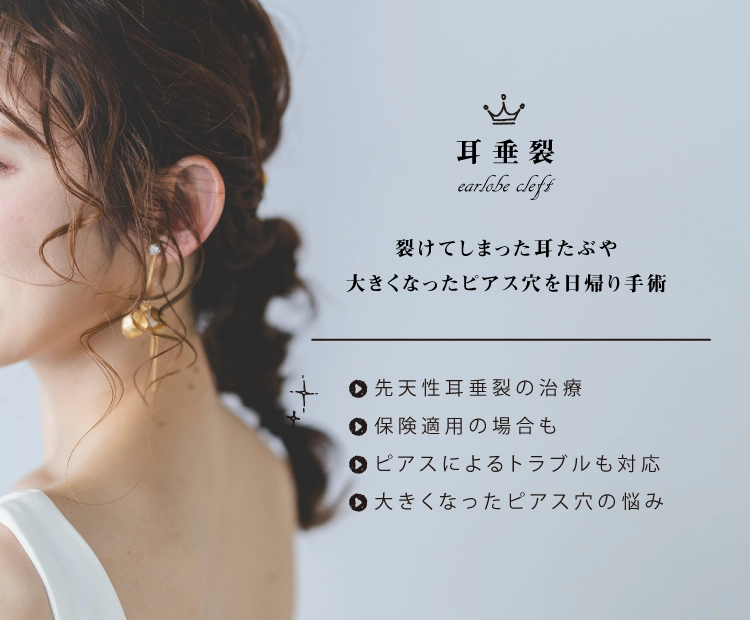 耳垂裂(裂け耳、切れ耳、耳切れ)でお悩みの方に日帰りの手術を行っております。