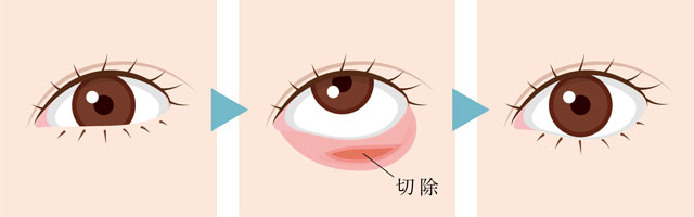 下眼瞼下制の治療方法