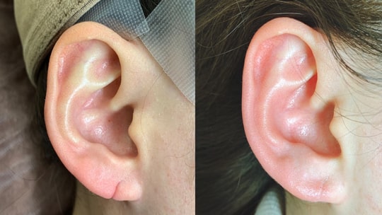 耳垂裂（耳切れ）の治療例
