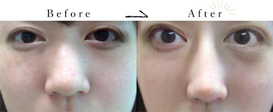 鼻を高くするプロテーゼによる隆鼻術｜名古屋市中区栄駅の美容皮膚科