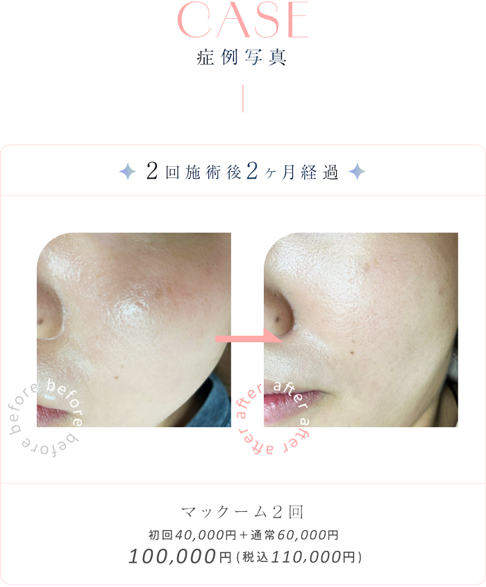 ドラッグデリバリーシステム CP25の症例写真