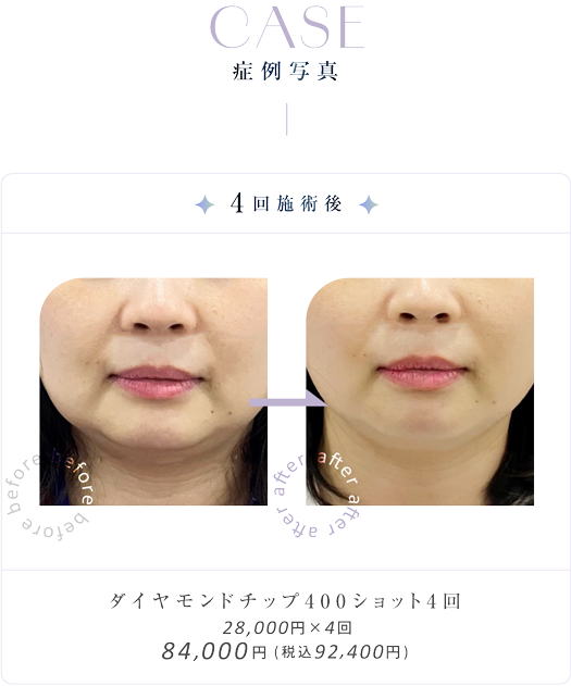 ダイヤモンドチップの症例写真